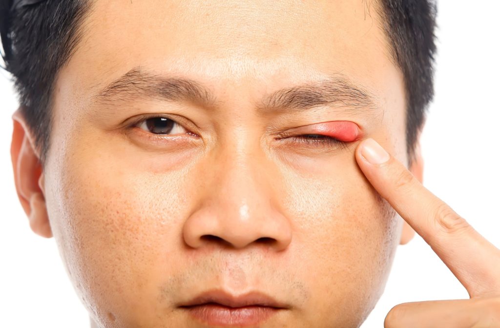 Close up of a man pointing at a large red bump or stye on his eyelid.