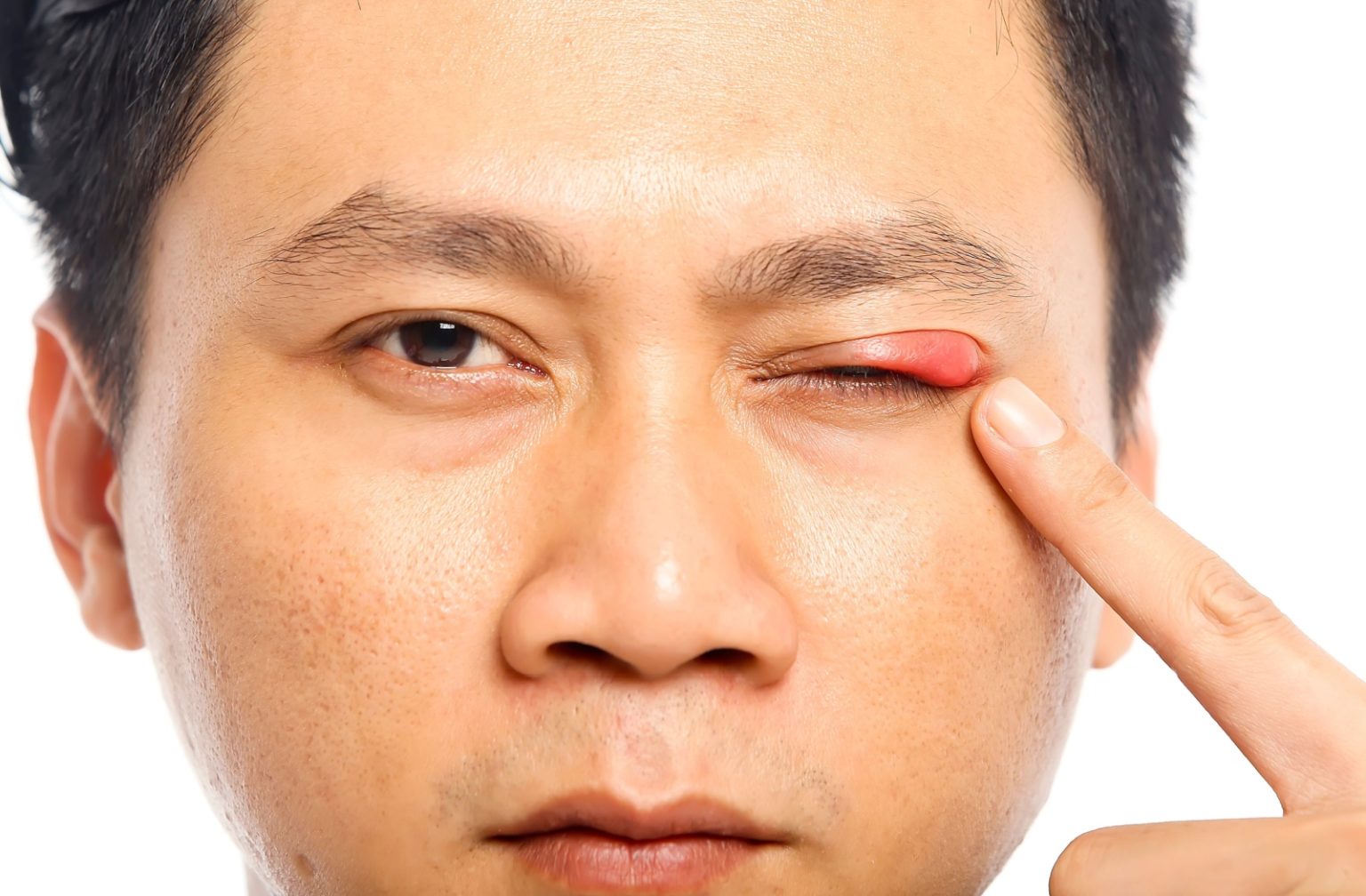 Stye vs. Conjunctivitis: How to Tell the Difference