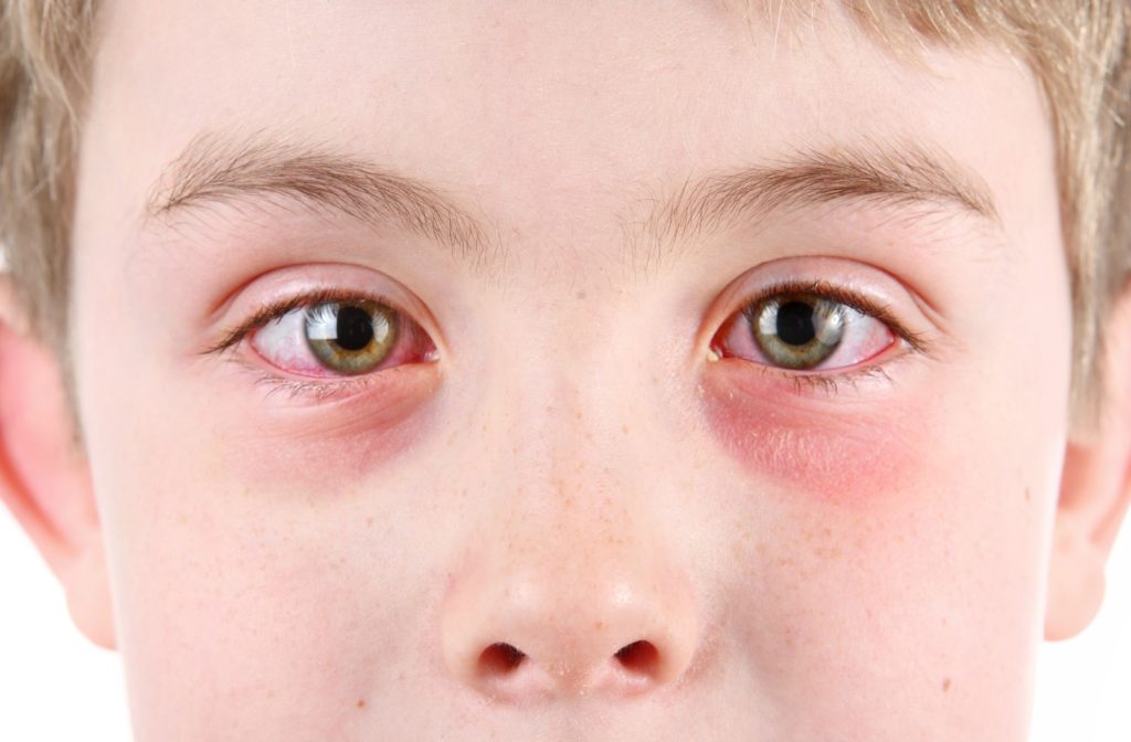Close-up of a young boy's red eyes indicating he has conjunctivitis.